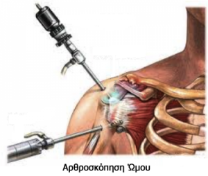 Shoulder-arthroscopy
